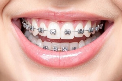 APARAT DENTAR FIX  (o arcada)