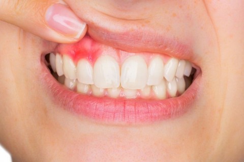 CHIURETAJ DENTAR PENTRU TRATAMENTUL INFLAMATIEI SI SANGERARII GINGIVALE