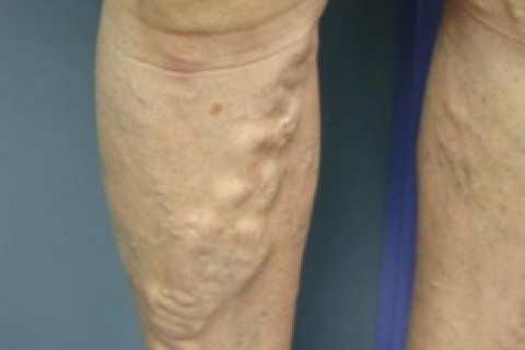 Ecografie doppler artere sau vene - un membru